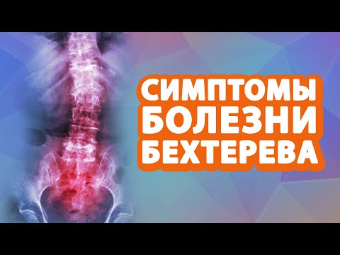 Симптомы болезни Бехтерева // Анкилозирующий спондилоартрит