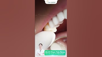 Cận cảnh trám sứ Overlay tại nha khoa Tracydnetist
