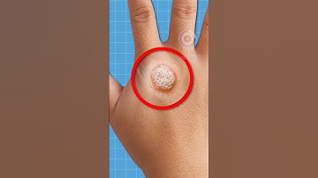 CÁCH CHỮA MỤN CÓC BẰNG ĐÔNG LẠNH | 😨 (Bạn Biết Không) #facts #amzingfacts #thaukinhtrithuc