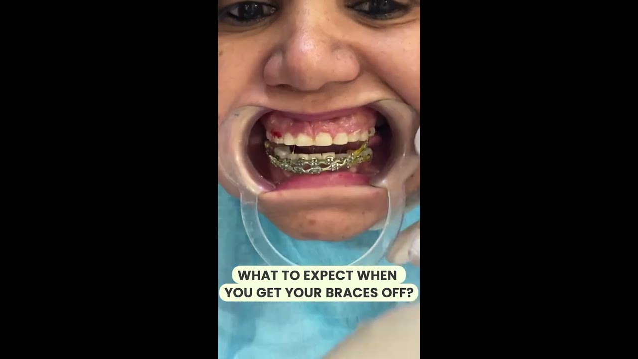 What To Expect When You Get Your Braces Off Shorts
