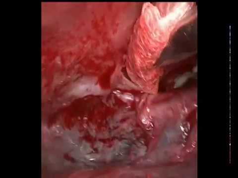 Эмпиема плевры - торакоскопия. Empyema - thoracoscopic treatment