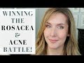 HOW I GOT RID OF ROSACEA AND ADULT ACNE | Products + Tips + Lifestyle Changes | My Story