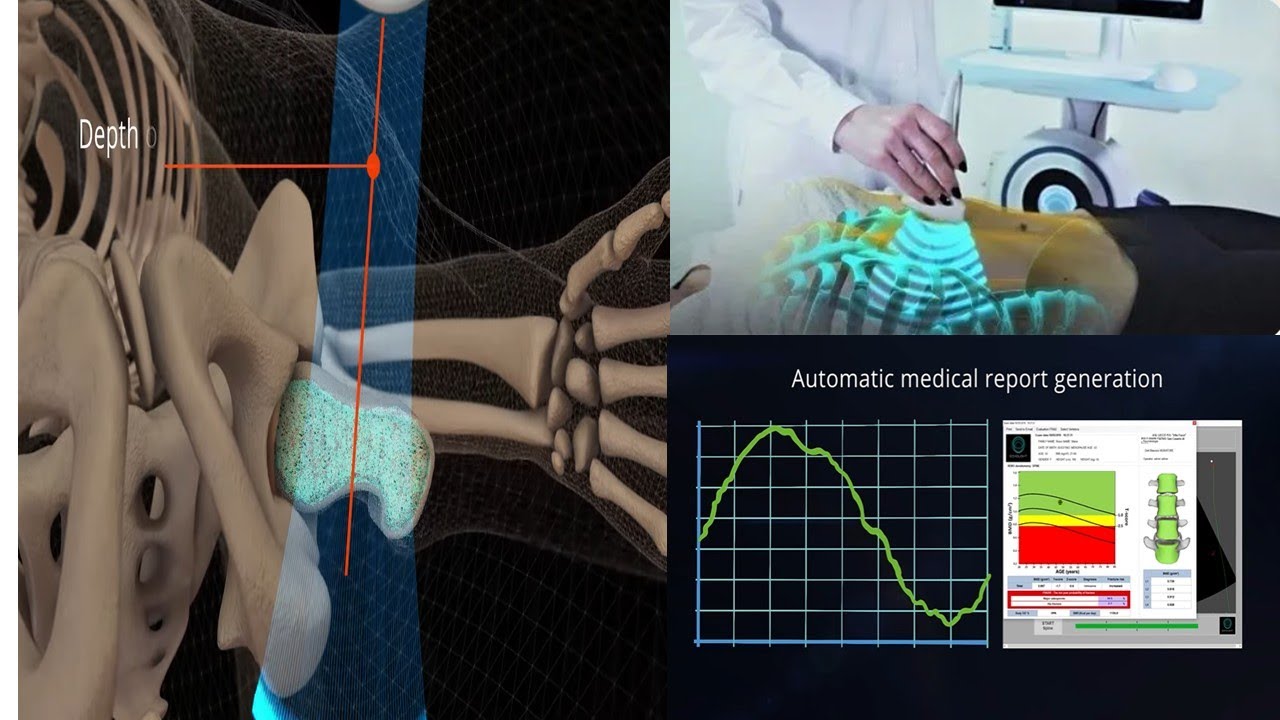 Echolight Scan EchoLight Bone Densitometry – Ultrasound Assessment of Bone Density ...