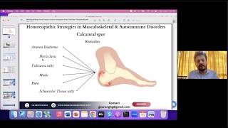 Homeopathic strategies in calcaneal spur -- Important clinical remedies in practice screenshot 5