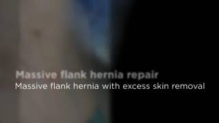 Abdominal Wall Reconstruction Mive Flank Hernia Repair. Life Changer Surgery