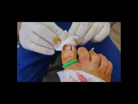 Performing a Wedge Resection For Ingrown Nails - YouTube