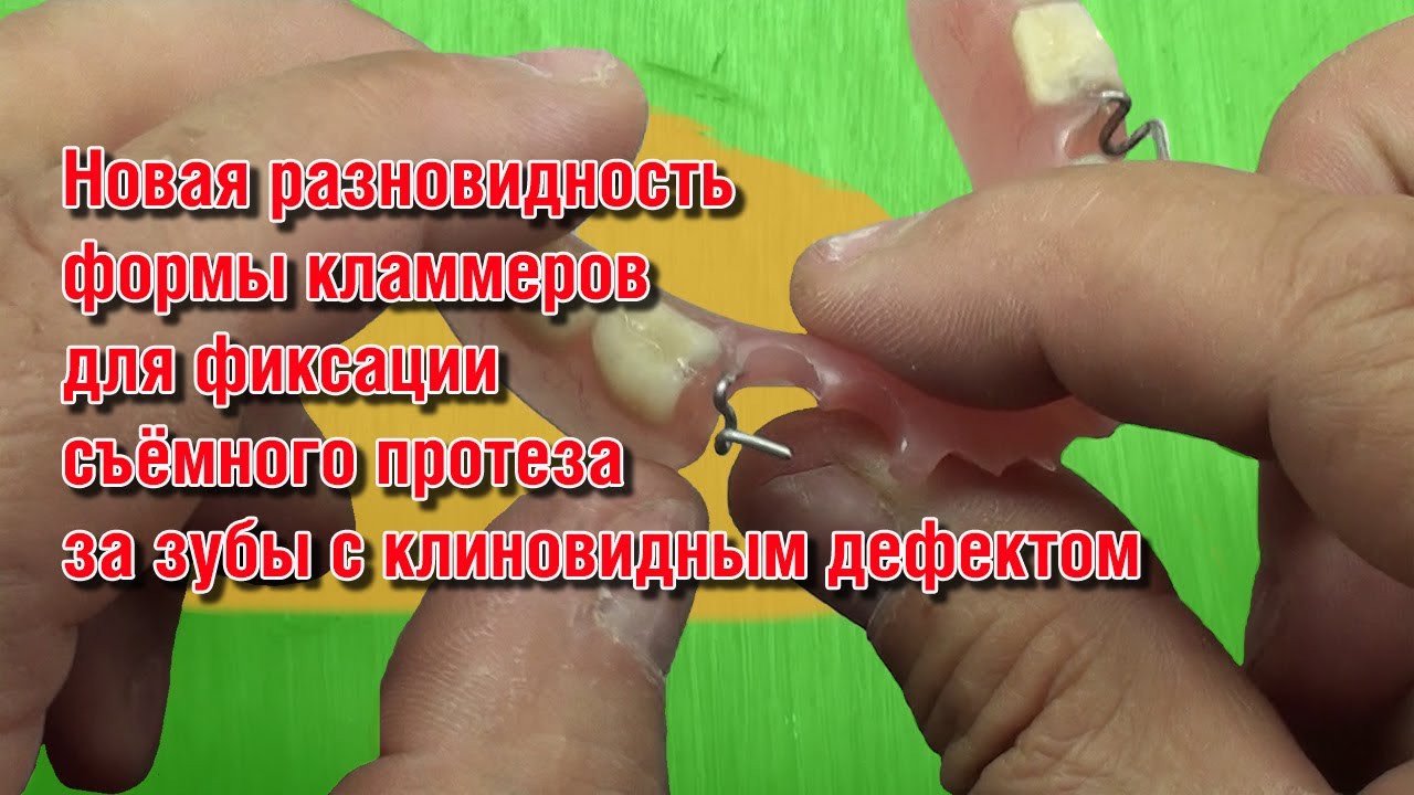 Новая разновидность формы кламмеров для фиксации съёмного протеза за ...