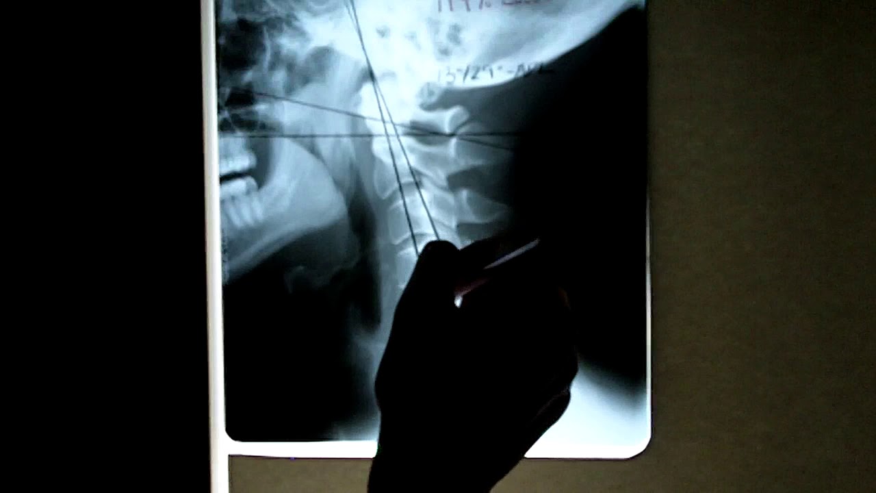 Cervical Analysis 2 video phone é a continuação de telephone