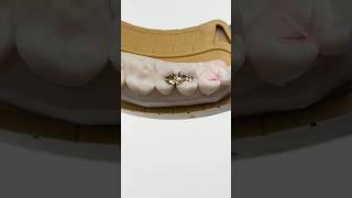 Two D Inlayonlays For Premolars