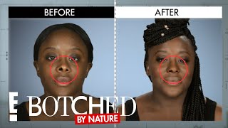 A Tube Deformed Devasha’s Nose When Born Premature | Botched by Nature on E! Entertainment