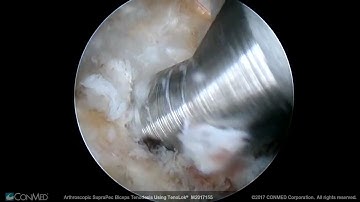 Dr. Patrick Henry. Arthroscopic SupraPec Biceps Tenodesis Using TenoLok®   CONMED Technique