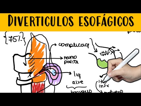 Video: 3 formas de tratar el divertículo esofágico