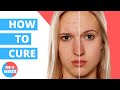 How to get rid of Acne? - Doctor Explains