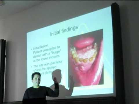 tobacco-smoking-and-oral-(mouth)-cancer---a-case-study