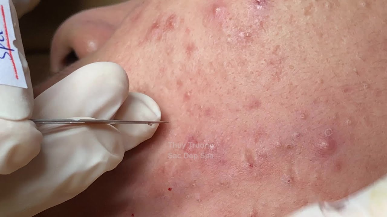 Long-Lasting White Acne Causes Wood Scars On The Face | Mụn Ẩn Để Lâu Gây Sẹo ThuyTruong#2