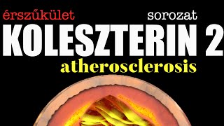 Atherosclerosis - érelmeszesedés