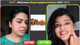 चेहरे के दाग-धब्बे  Pigmentation हटाने का आसान घरेलू उपाय  | Glowing और चमकदार त्वचा का राज़ !