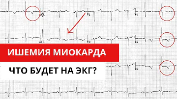 Нюансы ЭКГ диагностики ИБС (ишемической болезни сердца).