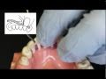 Ribbond Periodontal Splint Technique