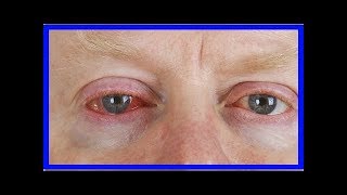 Die Augengrippe grassiert
