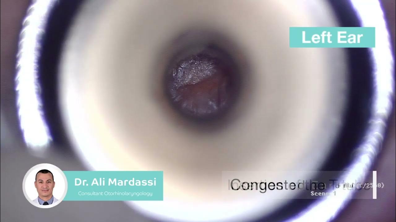 Serous otitis Media Tympanotomy Grommet Ttubes Insertion Dr Ali