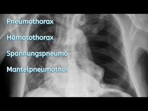 Video: Gleichzeitige Lungenhypoplasie Und Angeborenes Lobaremphysem Bei Einem Jungen Hund Mit Spannungspneumothorax: Eine Seltene Angeborene Lungenanomalie