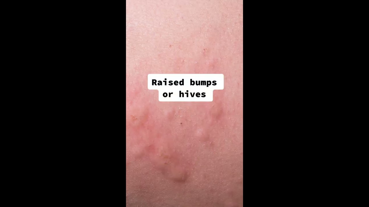 Signs You Re Allergic To Your Sunscreen According A Dermatologist Shorts