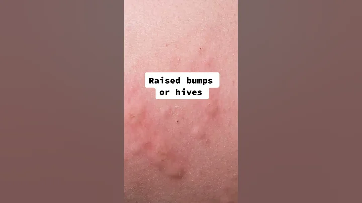 Signs You're Allergic to Your Sunscreen According to a Dermatologist #shorts