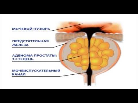 Стадии развития аденомы предстательной железы