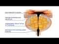 Стадии развития аденомы предстательной железы