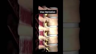 Disc Herniation #recovery#physiotherapyinterventions#physicalrehabilitation #sciatica