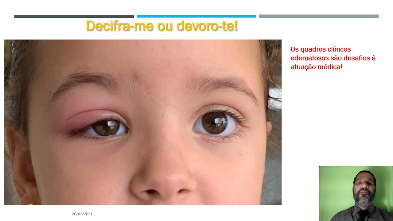 Aula III Abordagem e Manejo clínico do Edema YouTube Aula III Abordagem e Manejo clínico do Edema YouTube