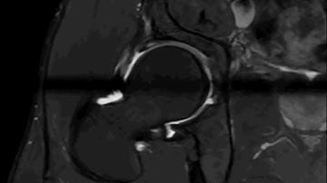 Mri hip arthrography radial sequence
