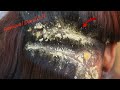 Scratching Dandruff Big Flakes Satisfying # 1514