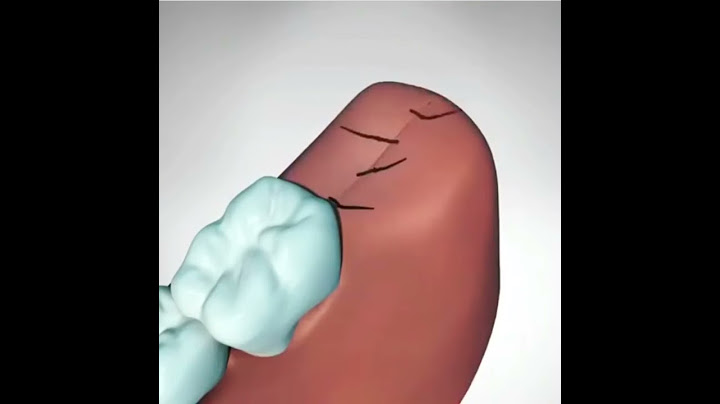 20'lik Dişin Cerrahi işlem ile alınması (Bilgelik Dişi)