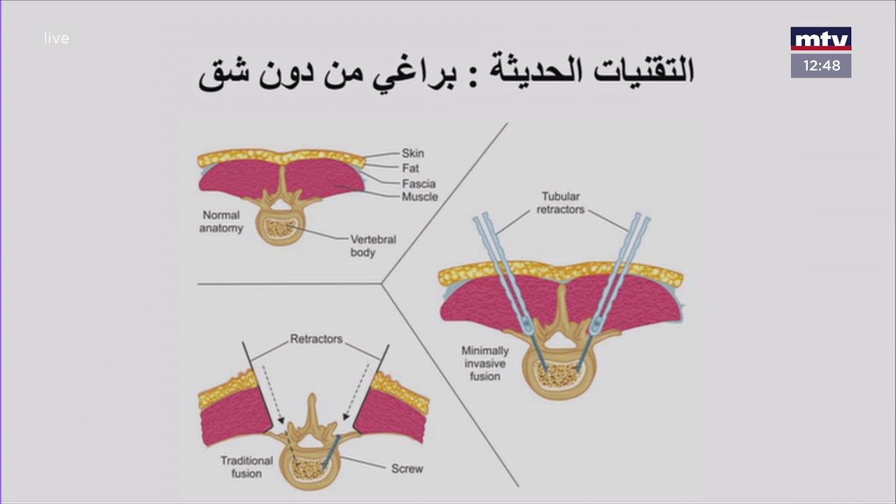 Sante - عملية تثبيت الفقرات في العامود الفقري (عملية البراغي في الضهر)