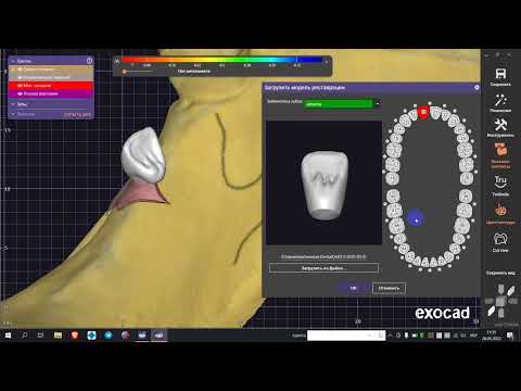 Sdfa To Stl Exocad V2
