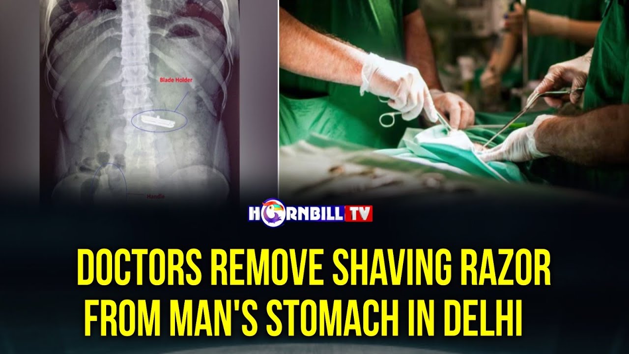 DOCTORS REMOVE SHAVING RAZOR FROM MAN'S STOMACH IN DELHI - YouTube