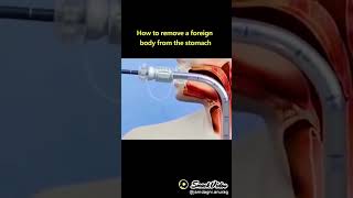 How to remove pin from stomach