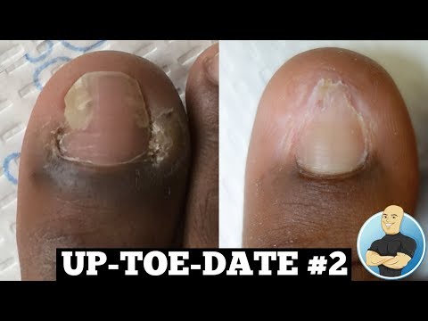 Before and After COMPLETELY HEALED!!! Ingrown Toenail Permanent Removal Surgery