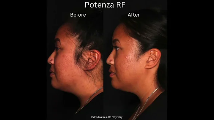 Potenza RF vs. Morpheus 8