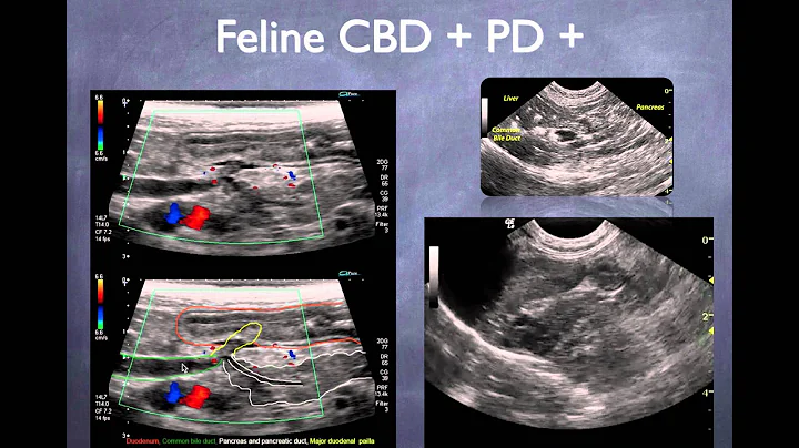 Common bile duct video presentation: Dr.Eric Lindq...