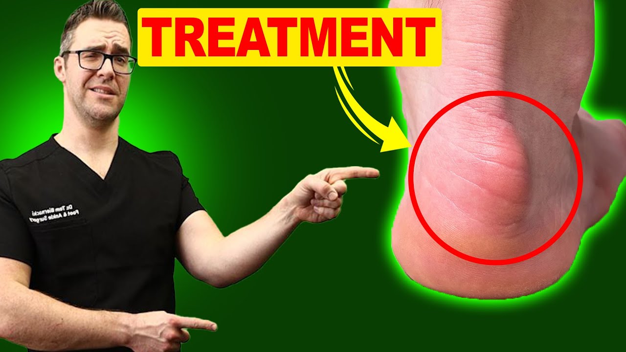 Retrocalcaneal Heel BURSITIS Treatment [Heel Pain Exercises & Massage] -  YouTube