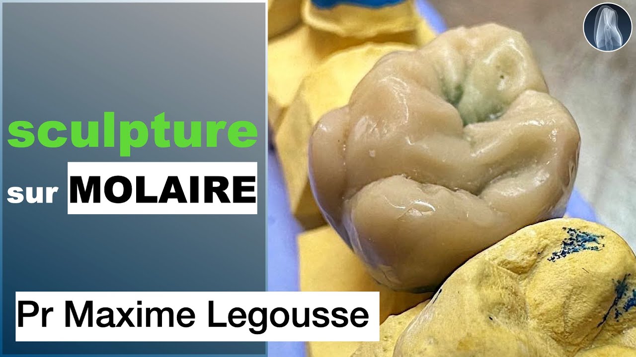 Sculpture Simplifiée d’une Molaire Maxillaire en Cire : Guide Étape par Étape ✨