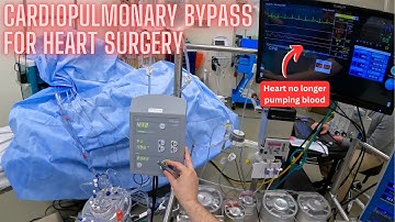 Going onto the heart-lung machine (cardiopulmonary bypass)