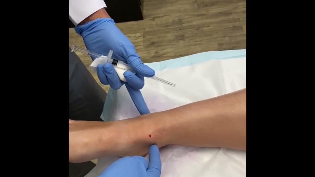 IntraArticular ankle injection YouTube
