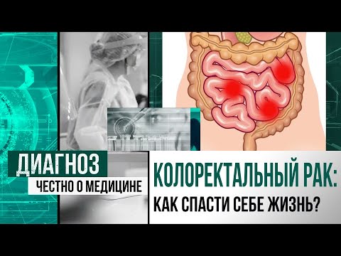 Жизнь без стомы: как при раке прямой кишки сохранить сфинктер | Диагноз