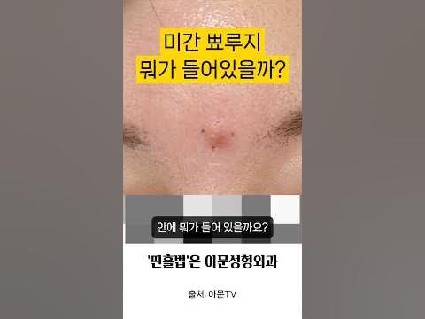 미간 뾰루지 안에 뭐가 있을까요? (핀홀법 수술 피지낭종 표피낭종 성형외과 병원 흉터 Epidermal Cyst Surgery ...