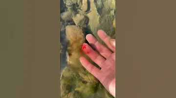 Stop Bleeding From Finger Wounds 