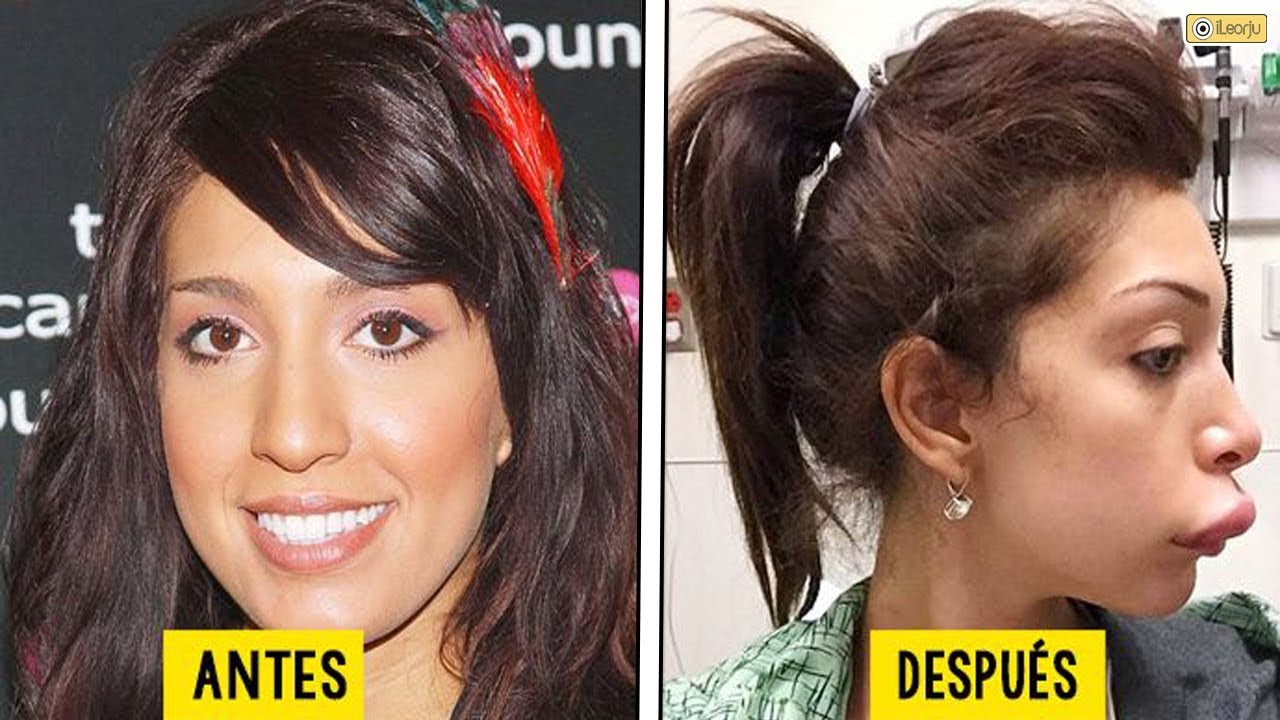 Cirugias Esteticas Mal Hechas En Famosos